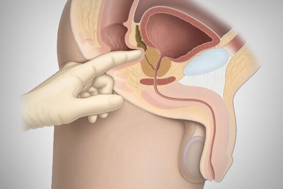 Масаж простати при бактеріальному простатиті